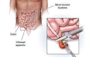 Appendix removal surgery