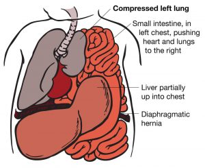 diaphragmatic hernia treatment