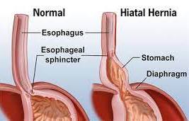 hiatus hernia 
