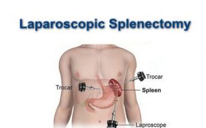 Spleen Surgery