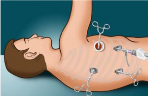 VATS surgery 